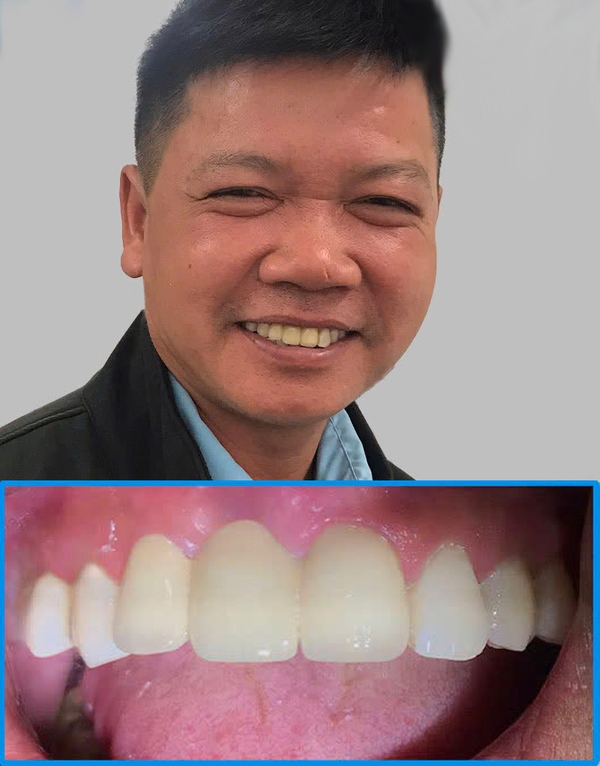 After full mouth dental implants — patient from Auckland New Zealand