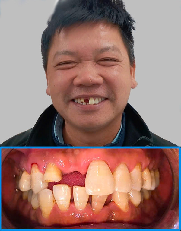 Before full mouth dental implants at Viet Bi Dental Vietnam